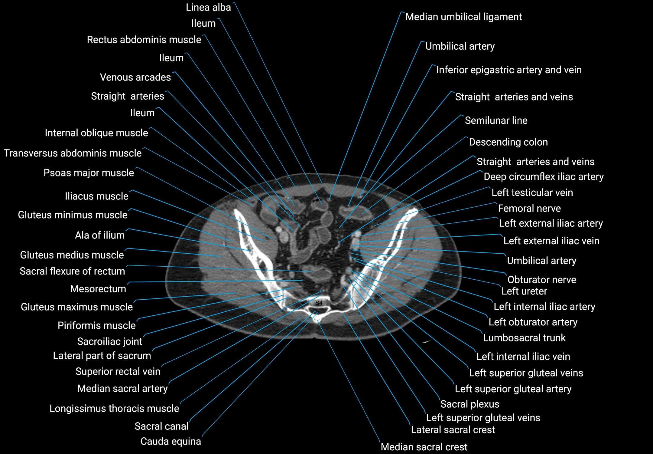 CT male pelvis axial cross sectional anatomy labelled radiology image -00160.webp
